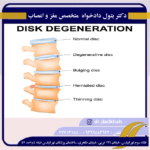 بیماری دژنراتیو دیسک چیست؟