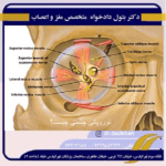 نوروپاتی چشمی (RPON) چیست؟